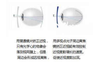 孩子眼睛度數(shù)持續(xù)加深？光學鏡片選擇與科學防控是關(guān)鍵
